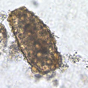 Ascaris_egg_unfert2_200x.jpg Figure B: Unfertilized egg of <em>A. lumbricoides</em> in an unstained wet mount, 200x magnification.