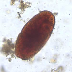Ascaris_egg_unfert_decort_200x.jpg Figure D: Unfertilized egg of <em>A. lumbricoides</em> in a wet mount of stool. Note this specimen lacks the mammillated layer (decorticated).