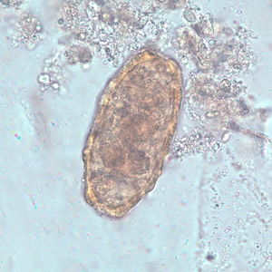 Ascaris_lumbrcoides_infertile_BAM1.jpg Figure C: Unfertilized egg of <em>A. lumbricoides</em> in an unstained wet mount of stool.