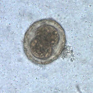Ascaris_egg_fert2_embryo.jpg Figure B: Fertilized egg of <em>A. lumbricoides</em> in unstained wet mounts of stool, with embryos in the early stage of development.