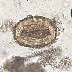 Ascaris_egg_fert5_embryo_200x.jpg Figure E: Fertilized egg of <em>A. lumbricoides</em> in an unstained wet mount of stool, 200x magnification. A larva is visible in the egg.