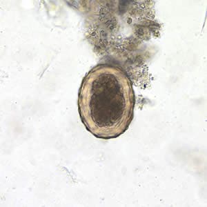 Ascaris_egg_fert_200x.jpg Figure F: Fertilized egg of <em>A. lumbricoides</em> in an unstained wet mount of stool.