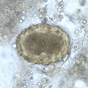 Ascaris_egg_fert_embryo.jpg Figure A: Fertilized egg of <em>A. lumbricoides</em> in unstained wet mounts of stool, with embryos in the early stage of development.