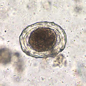 Ascaris_egg_fert_decort_200x.jpg Figure A: <em>A. lumbricoides</em> decorticated, fertile egg in wet mounts, 200x magnification.