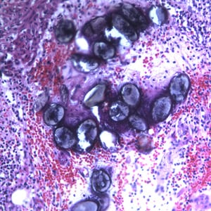 Ascaris_eggs_tissue_200x_BAM1.jpg Figure C: Eggs of <em>A. lumbricoides</em> in an appendix biopsy, stained with H&E. This image was taken at 200x magnification.