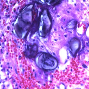 Ascaris_eggs_tissue_400x_BAM1.jpg Figure D: Eggs of <em>A. lumbricoides</em> in an appendix biopsy, stained with H&E. This image was taken at 400x magnification.