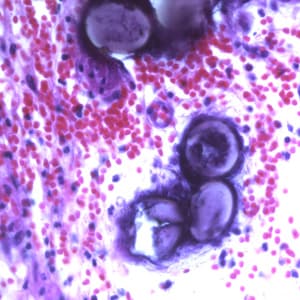Ascaris_eggs_tissue_400x_BAM2.jpg Figure E: Eggs of <em>A. lumbricoides</em> in an appendix biopsy, stained with H&E. Image taken at 400x magnification.