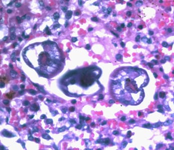 Ascaris_larvae_tissue_400x_BAM1.jpg Figure A: L3 larvae of <em>A. lumbricoides</em> in lung tissue, stained with H&E. Image taken at 400x magnification.