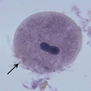 Bcoli_troph_hematoxylin.jpg Figure E: <em>B. coli</em> trophozoite in a Mann's hematoxylin stained smear, 500× magnification. Note the cytosome (black arrow) and the bean shaped macronucleus.