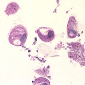 Bcoli_troph_hande2_colon.jpg Figure B: <em>B. coli</em> trophozoites in colon tissue stained with hematoxylin and eosin (H&E) at 400x magnification.