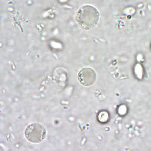 Bhominis_cyst_wtmt.jpg Figure A