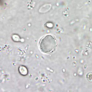Bhominis_cyst_wtmt2.jpg Figure B