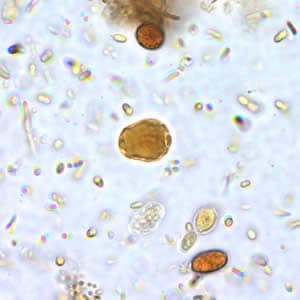 Bhominis_cyst_wtmt_io.jpg Figure A