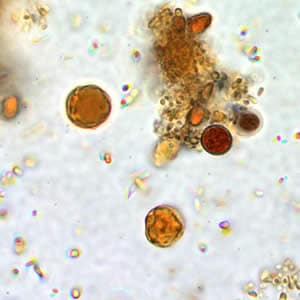 Bhominis_cyst_wtmt_io2.jpg Figure B