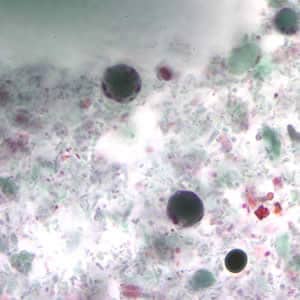 Bhominis_cyst_tric2.jpg Figure B