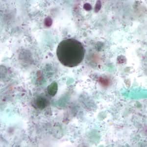 Bhominis_cyst_tric3.jpg Figure C