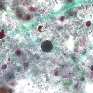 Bhominis_cyst_tric4.jpg Figure D