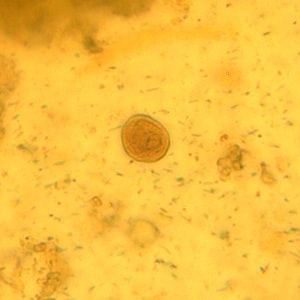 C_mesnili_cyst_wtmt_BM2.jpg Figure B: Cyst of <em>C. mesnili</em> in a concentrated wet mount of stool, stained with iodine. Image taken at 1000x magnification.