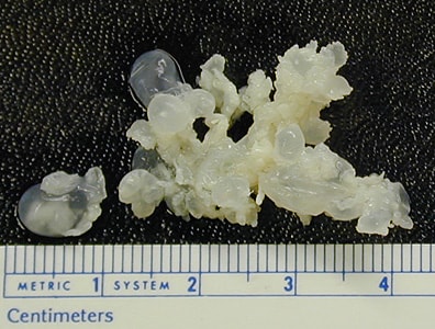 Coenurus_BAM2.jpg Figure A: Large, polycephalic coenurus removed from the shoulder of a baboon (Papio sp.).