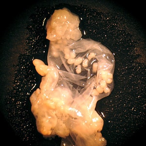 Coenurus_BAM3.jpg Figure B: Close-up of a coenurus of <em>T. multiceps</em> removed from the eye of a patient, broken open to show multiple protoscolices.