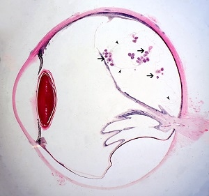 eye_A Figure A: Cross-section of a human eye, showing multiple protoscoleces within a coenurus (arrows) and very thin bladder walls (darts).