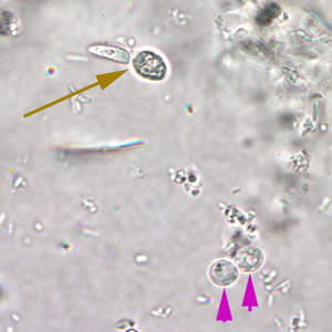 Crypto_wtmt_annot.jpg Figure A: <em>Cryptosporidium</em> spp. oocysts (pink arrows) in wet mount. A budding yeast (brown arrow) is in the same field.