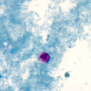 Crypto_acidfast2_web.jpg Figure D: <em>Cryptosporidium</em> sp. oocyst stained with modified acid-fast.