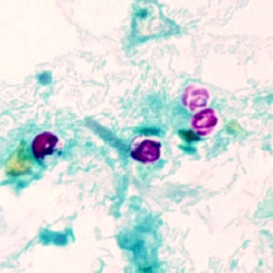 Crypto_oocyst4.jpg Figure A: <em>Cryptosporidium parvum</em> oocysts stained with modified acid-fast. Against a blue-green background, the oocysts stand out in a bright red stain. Sporozoites are visible inside the two oocysts to the right in this image.
