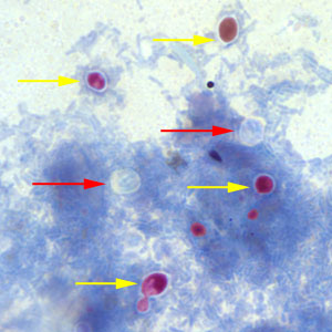 Crypto_acidfast1_100x_annot.jpg Figure A: <em>Cryptosporidium</em> sp. oocysts (red arrows) that did not take up the modified acid-fast stain. The slide was counterstained with methylene blue. Note that yeast cells did stain red (yellow arrows).