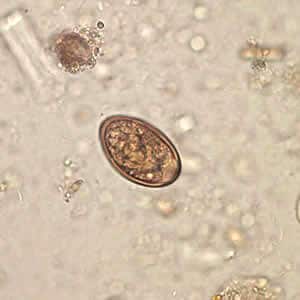 D_dendriticum_egg_wtmt_JCG_B.jpg Figure A: Egg of <em>Dicrocoelium dendriticum</em> in an unstained wet mount of stool. Image courtesy of Dr. Juan Cuadros González.