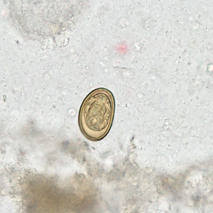 Dicrocoelium_HB1.jpg Figure C: Egg of <em>D. dendriticum</em> in an unstained wet mount of stool.