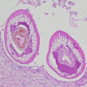 Dioctophyme_LTU_A.jpg Figure A: Cross-sections of larvae of <em>D. renale</em> in a subcutaneous nodule, stained with hematoxylin and eosin (H&E). Images courtesy of the Laboratory of Parasitology, National Public Health Research Center in Vilnius, Lithuania