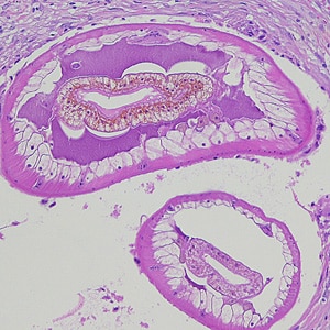 Dioctophyme_LTU_B.jpg Figure B: Cross-sections of larvae of <em>D. renale</em> in a subcutaneous nodule, stained with hematoxylin and eosin (H&E). Images courtesy of the Laboratory of Parasitology, National Public Health Research Center in Vilnius, Lithuania