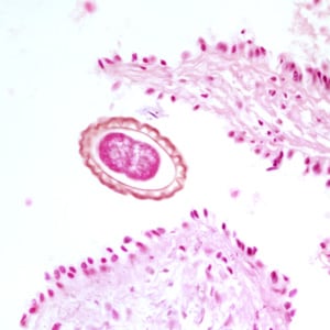 D_renale_egg_tissue3.jpg Figure B: Egg of <em>D. renale</em> in the kidney of a mink, stained with hematoxylin and eosin (H&E).
