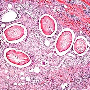 Dirofilaria_DerksB.jpg Figure C: Cross-sections of <em>Dirofilaria</em> sp. from a subcutaneous nodule above the right breast of a female patient who traveled to several western European countries, stained with H&E. Image taken at 100x magnification. Image courtesy of Dr. Truus Derks.