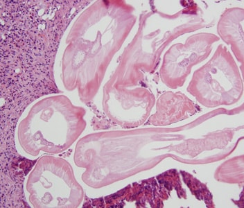 Dirofilaria_Univ_MI.jpg Figure B: Cross-sections of <em>Dirofilaria</em> spp. from a subcutaneous scalp nodule, stained with H&E. Image courtesy of the Department of Dermatopathology, University of Michigan, Ann Arbor, MI.