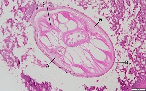 SQ_Dt_A Figure A: Cross-section of <em>Dirofilaria tenuis</em> from a subcutaneous nodule in a patient from Florida. Note the internal lateral ridge (A); multi-layered, ridged cuticle (B); and tall musculature (C). This specimen is somewhat degenerated, a common finding in dirofilariasis cases.