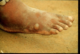 Figure A: The female Guinea worm induces a painful blister.