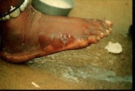 Figure B: after rupture of the blister, the worm emerges as a whitish filament in the center of a painful ulcer which is often secondarily infected. (Images contributed by Global 2000/The Carter Center, Atlanta, Georgia).