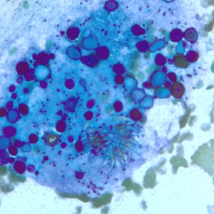 EchinococcusCellNetix_E.jpg Figure E: Degenerating protoscolex from a liver cyst, stained with PAP. Notice the conspicuous calcareous corpuscles, characteristic of cestode infections.