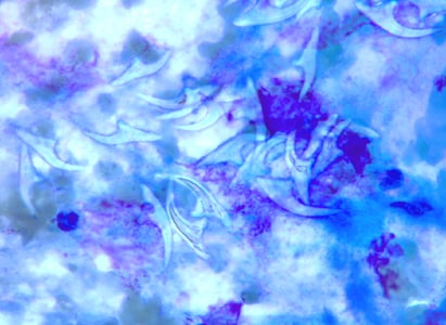 EchinococcusCellNetix_F.jpg Figure F: Free hooklets in 'hydatid sand' from the aspirate of a liver cyst, stained with PAP.