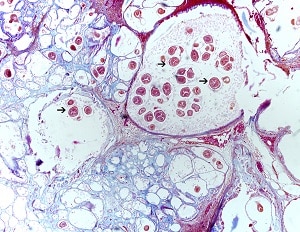 Em_cyst_tri Figure D