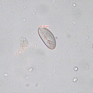 Evermicularis_SC_egg.jpg Figure D: Egg of <em>E. vermicularis</em> teased from an adult worm recovered from a colonoscopy. Image contributed by the South Carolina Department of Health and Environmental Control, Bureau of Laboratories.