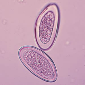 Evermicularis_egg_HBa.jpg Figure B: Eggs of <em>E. vermicularis</em> in a wet mount.