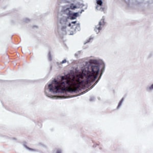 E_vermicularis_eggs_tissue1.jpg Figure E: Egg of <em>E. vermicularis</em> in a colon biopsy specimen, stained with H&E.