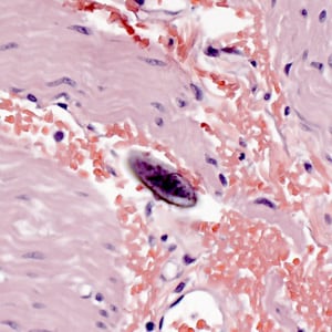 E_vermicularis_eggs_tissue2.jpg Figure F: Egg of <em>E. vermicularis</em> in a colon biopsy specimen, stained with H&E.