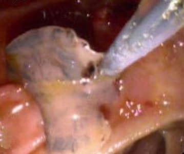 Figure A: Adult of <em>F. hepatica</em> observed with ERCP imaging in the common bile duct of a human patient. Image courtesy of Dr. Subhash Agal, Kokilaben Dhirubhai Ambani Hospital, Mumbai, India.