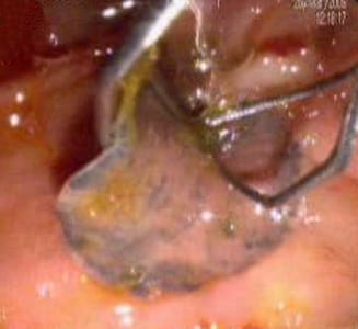 Figure B: Adult of <em>F. hepatica</em> observed with ERCP imaging in the common bile duct of a human patient. Image courtesy of Dr. Subhash Agal, Kokilaben Dhirubhai Ambani Hospital, Mumbai, India.
