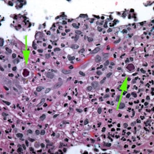 Acanthamoeba_HE_Vish2.jpg Figure E: Cysts of <em>Acanthamoeba</em> sp. (green arrows) in tissue, stained with H&E.