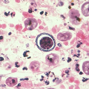 Acanthamoeba_HE_Vish3.jpg Figure C: Cyst of <em>Acanthamoeba</em> sp. from brain tissue, stained with hematoxylin and eosin (H&E).
